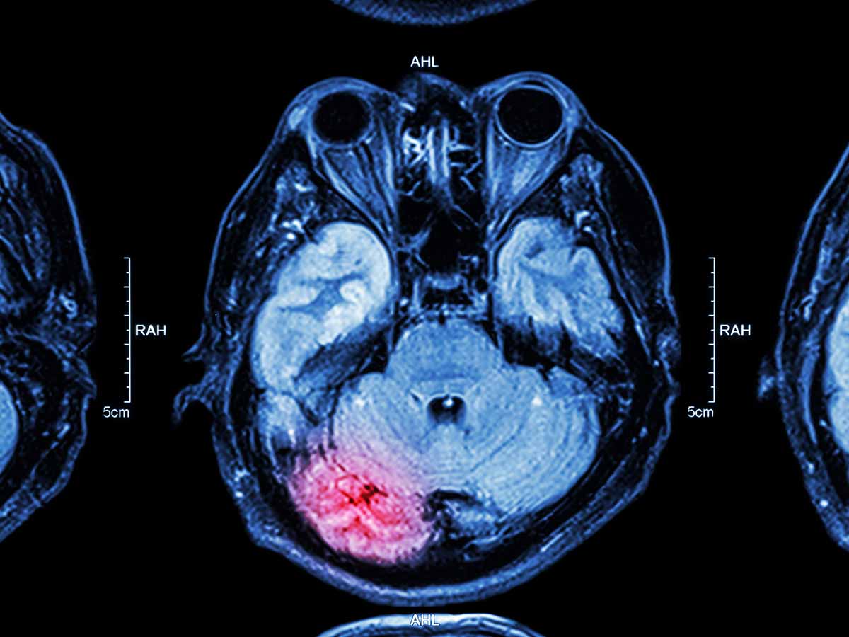 Long-Term Effects of a TTBI | Key Information to Know
